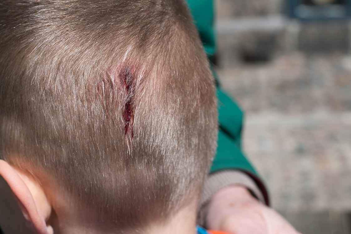 The back of someone's head with an injury.