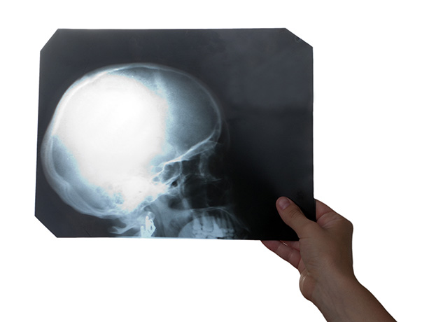 Are There Any Differences Between A Brain Injury and A Head Injury?